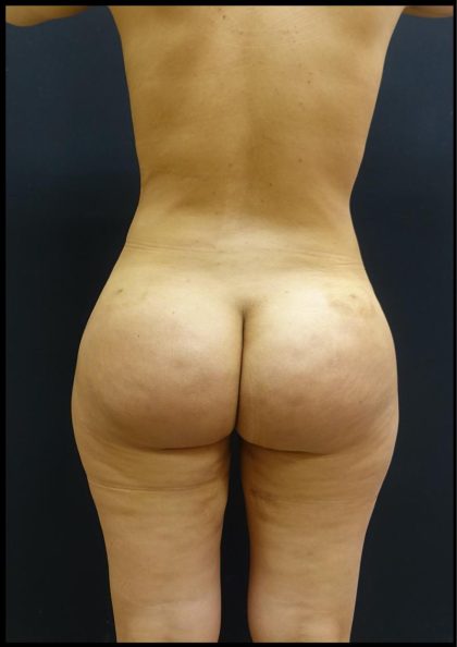 Brazilian Butt Lift Before & After Patient #6197