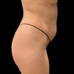 Brazilian Butt Lift Before & After Patient #6248
