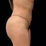 Brazilian Butt Lift Before & After Patient #6248