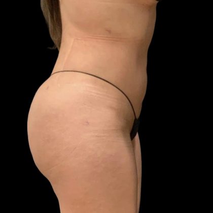 Brazilian Butt Lift Before & After Patient #6248