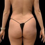 Brazilian Butt Lift Before & After Patient #6248