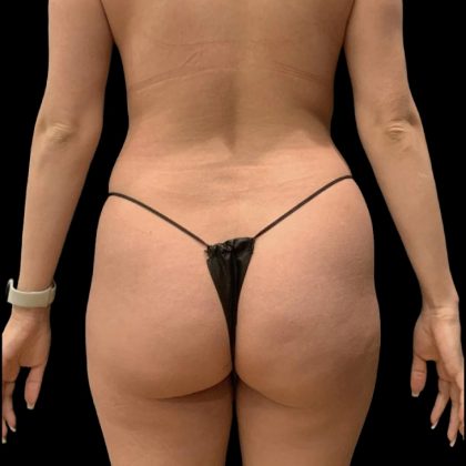 Brazilian Butt Lift Before & After Patient #6248