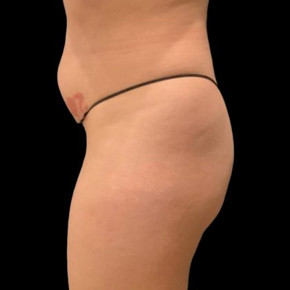 Brazilian Butt Lift Before & After Patient #6248