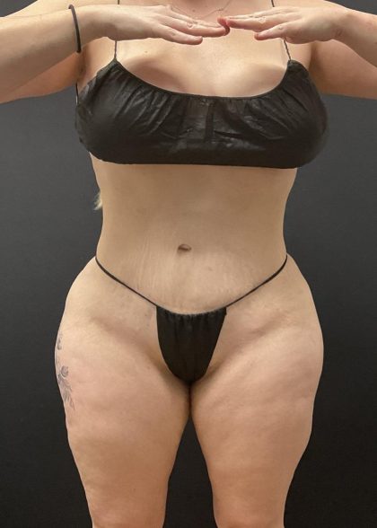 Brazilian Butt Lift Before & After Patient #6250