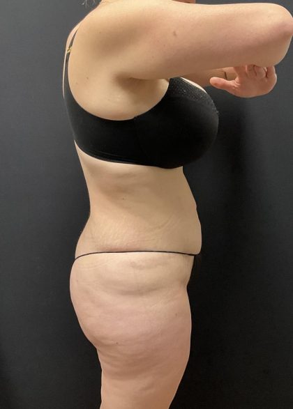 Brazilian Butt Lift Before & After Patient #6250