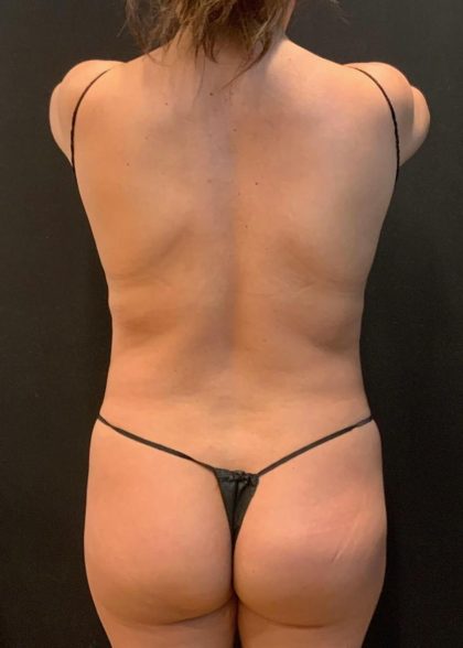 Brazilian Butt Lift Before & After Patient #5951