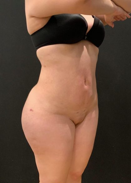 Brazilian Butt Lift Before & After Patient #5967
