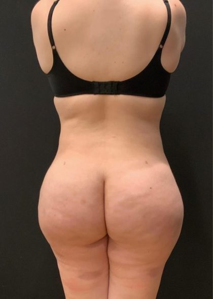 Brazilian Butt Lift Before & After Patient #5967