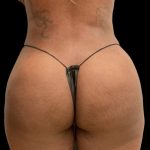 Brazilian Butt Lift Before & After Patient #5978
