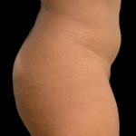Brazilian Butt Lift Before & After Patient #5978