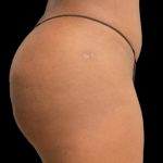Brazilian Butt Lift Before & After Patient #5978
