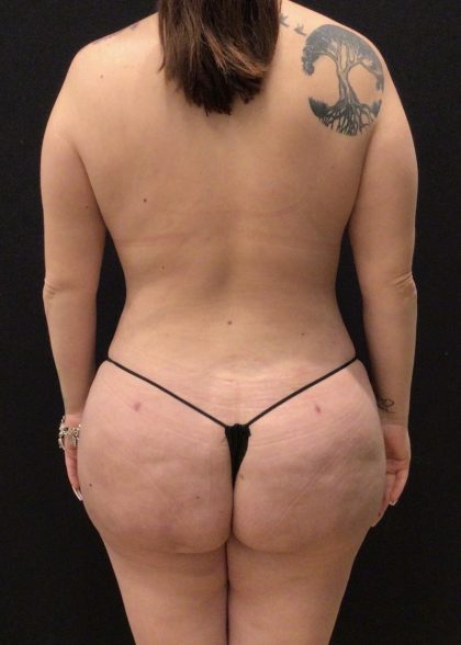 Brazilian Butt Lift Before & After Patient #5987
