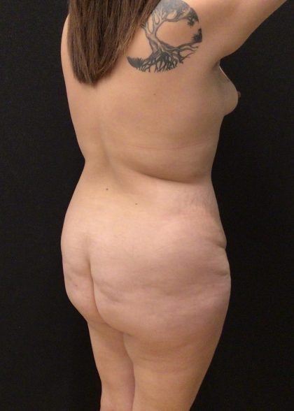 Brazilian Butt Lift Before & After Patient #5987
