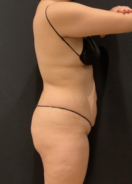 Brazilian Butt Lift Before & After Patient #6001