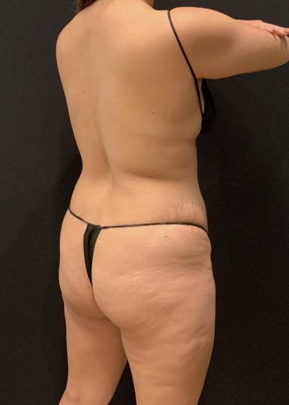 Brazilian Butt Lift Before & After Patient #6001