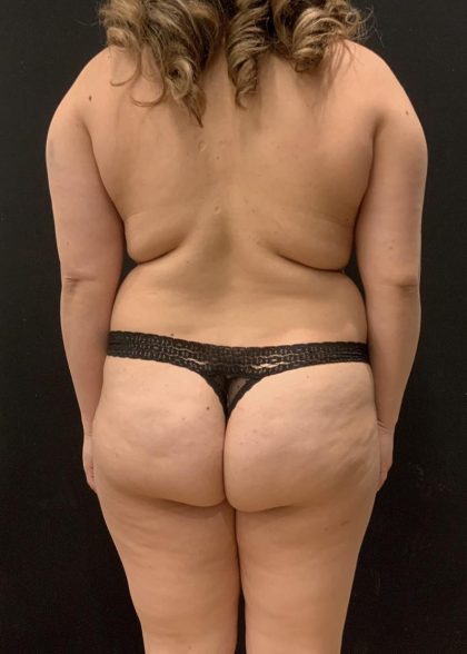 Brazilian Butt Lift Before & After Patient #6039