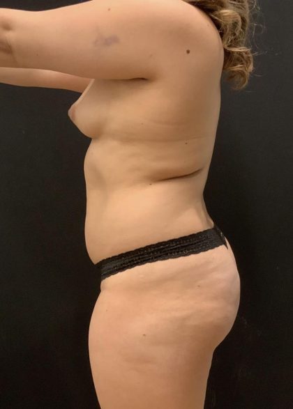 Brazilian Butt Lift Before & After Patient #6039