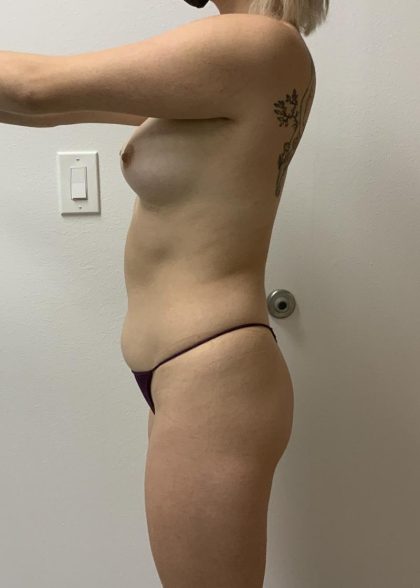 Brazilian Butt Lift Before & After Patient #6104