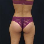 Butt Implants Before & After Patient #6252