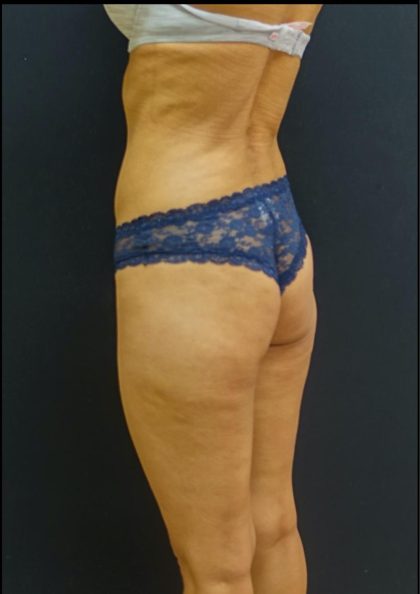 Butt Implants Before & After Patient #6252