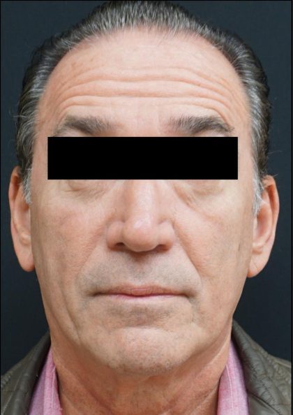 Blepharoplasty Before & After Patient #6498