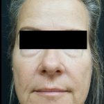 Blepharoplasty Before & After Patient #6495