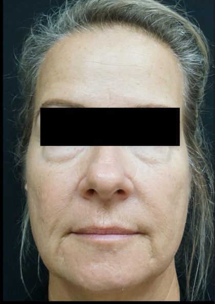 Blepharoplasty Before & After Patient #6495
