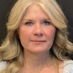 Blepharoplasty Before & After Patient #6497