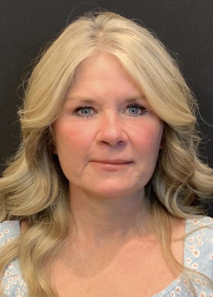 Blepharoplasty Before & After Patient #6497