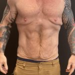 Body Lift Before & After Patient #6260