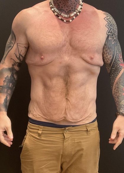 Body Lift Before & After Patient #6260
