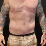 Body Lift Before & After Patient #6260