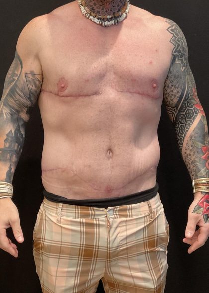 Body Lift Before & After Patient #6260