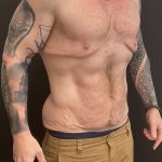 Body Lift Before & After Patient #6260