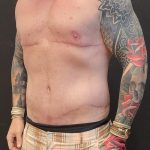 Body Lift Before & After Patient #6260