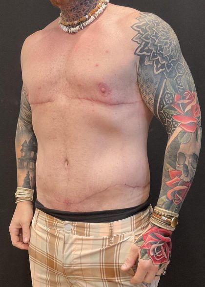 Body Lift Before & After Patient #6260