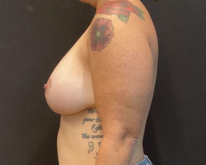 Breast Lift Before & After Patient #6306