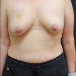 Breast Lift Before & After Patient #6574
