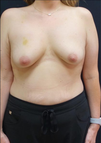 Breast Lift Before & After Patient #6574