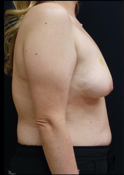 Breast Lift Before & After Patient #6574