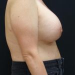 Breast Lift Before & After Patient #6574