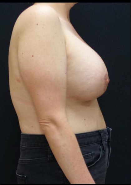 Breast Lift Before & After Patient #6574