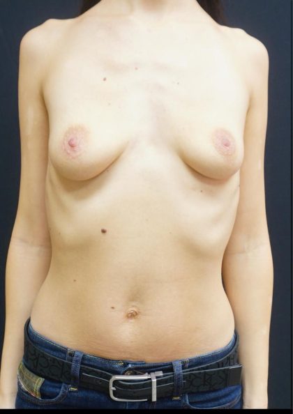 Breast Lift Before & After Patient #6576