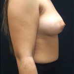 Breast Lift Before & After Patient #6577