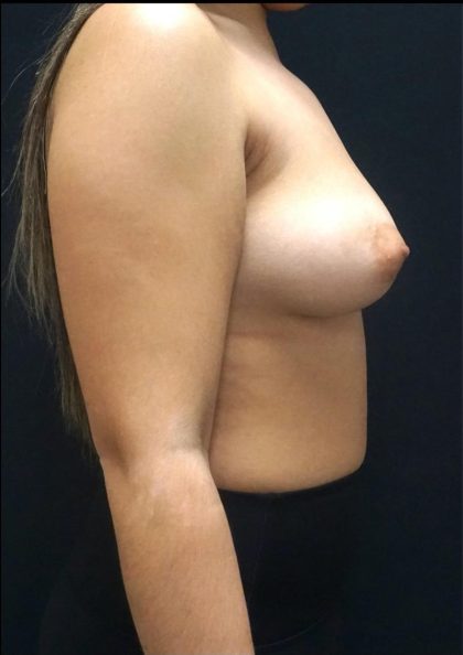 Breast Lift Before & After Patient #6577