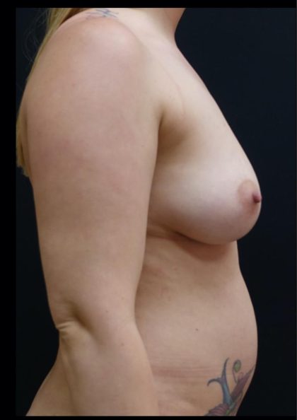 Breast Lift Before & After Patient #6578