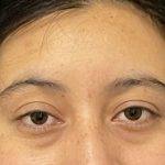 Brow Lift Before & After Patient #6721