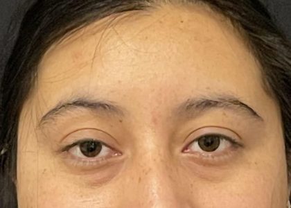 Brow Lift Before & After Patient #6721