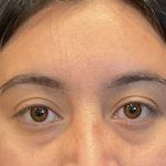 Brow Lift Before & After Patient #6721