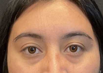 Brow Lift Before & After Patient #6721